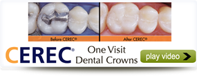 cerec