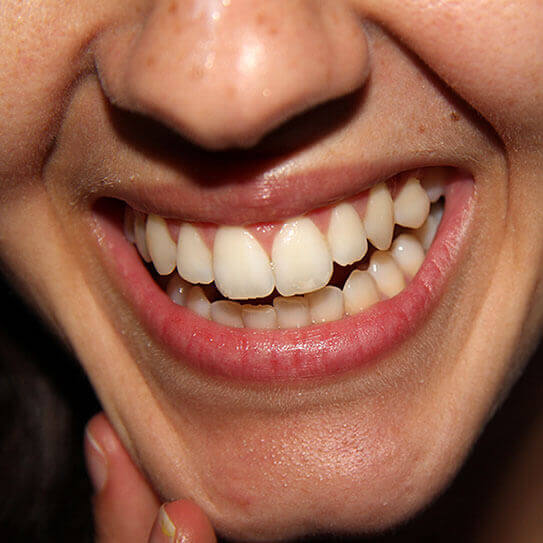 What Are Those White Spots On My Teeth?