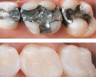 White Fillings